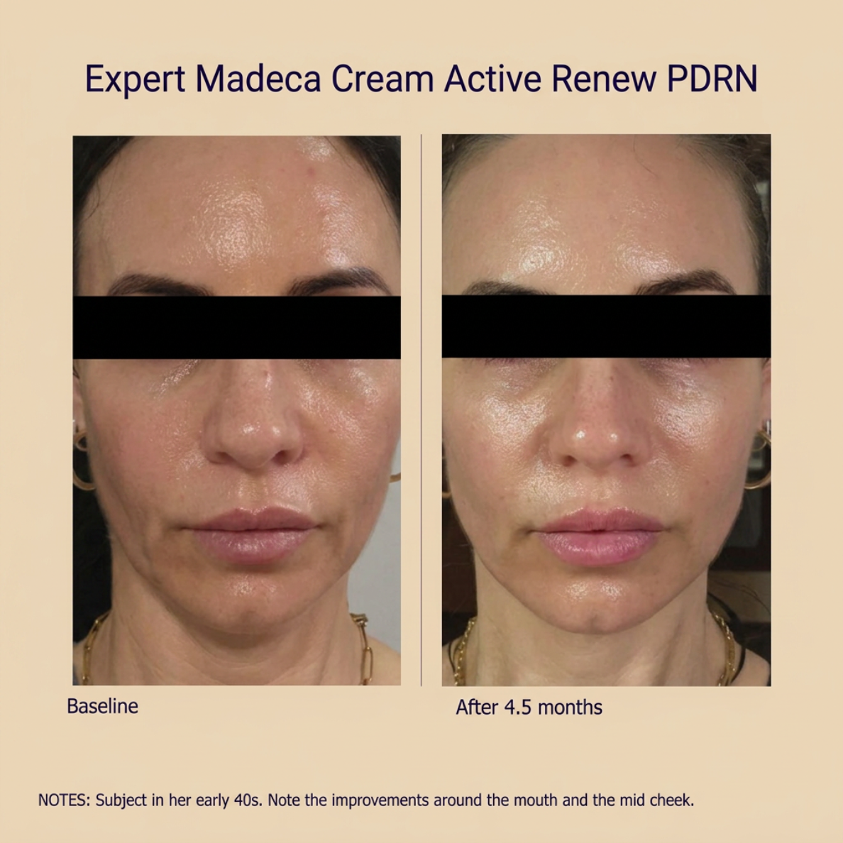 Korean Expert Madeca Cream PDRN