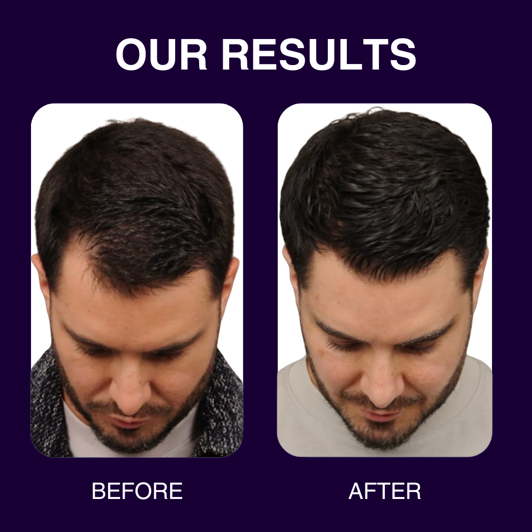 Restoring Hair Loss Growth Serum